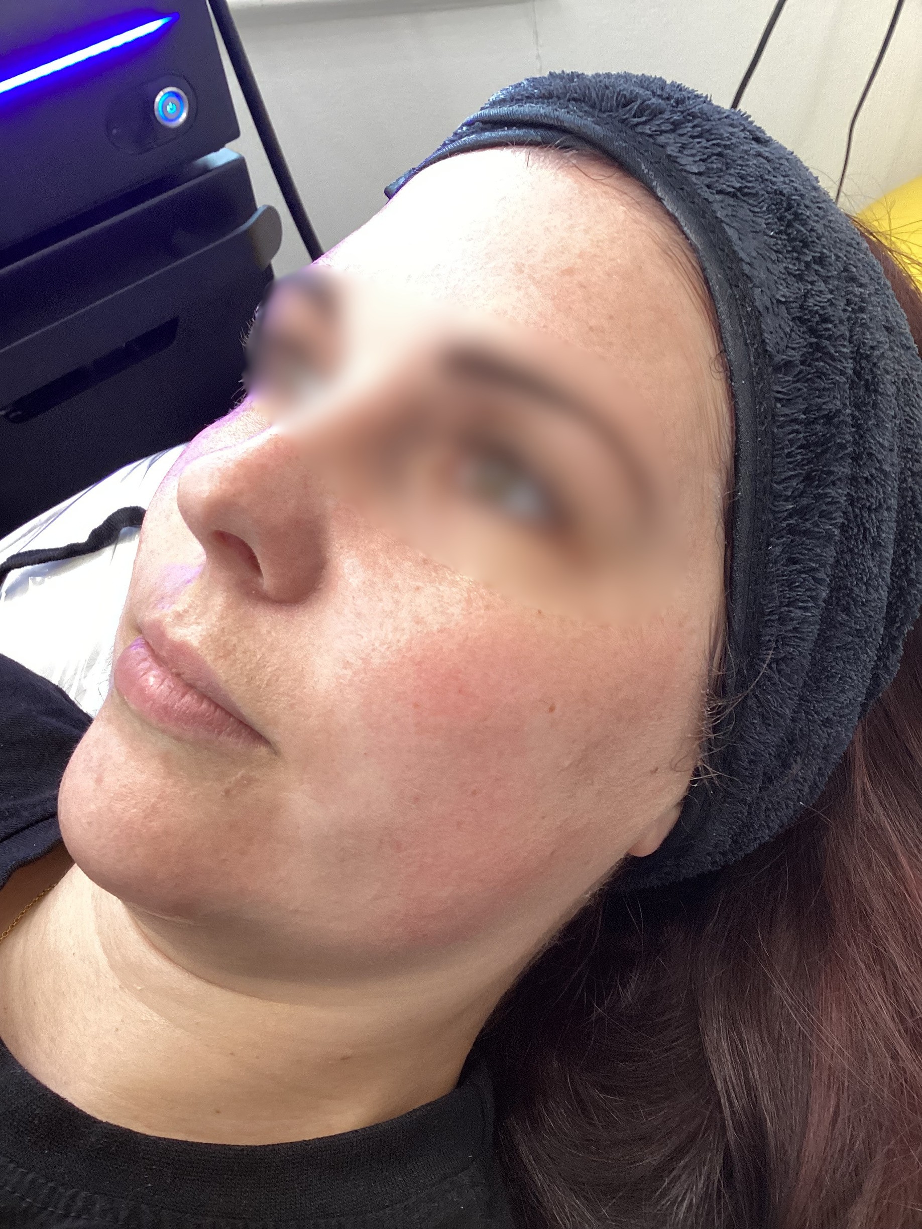 Laser treatment on woman's cheek with protective eye shield