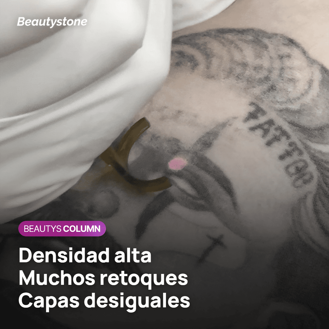 Densidad del pigmento del irezumi y respuesta al láser