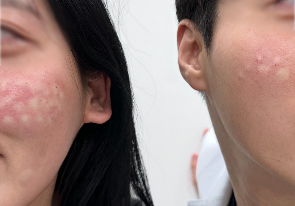 Before and after acne treatment on facial skin