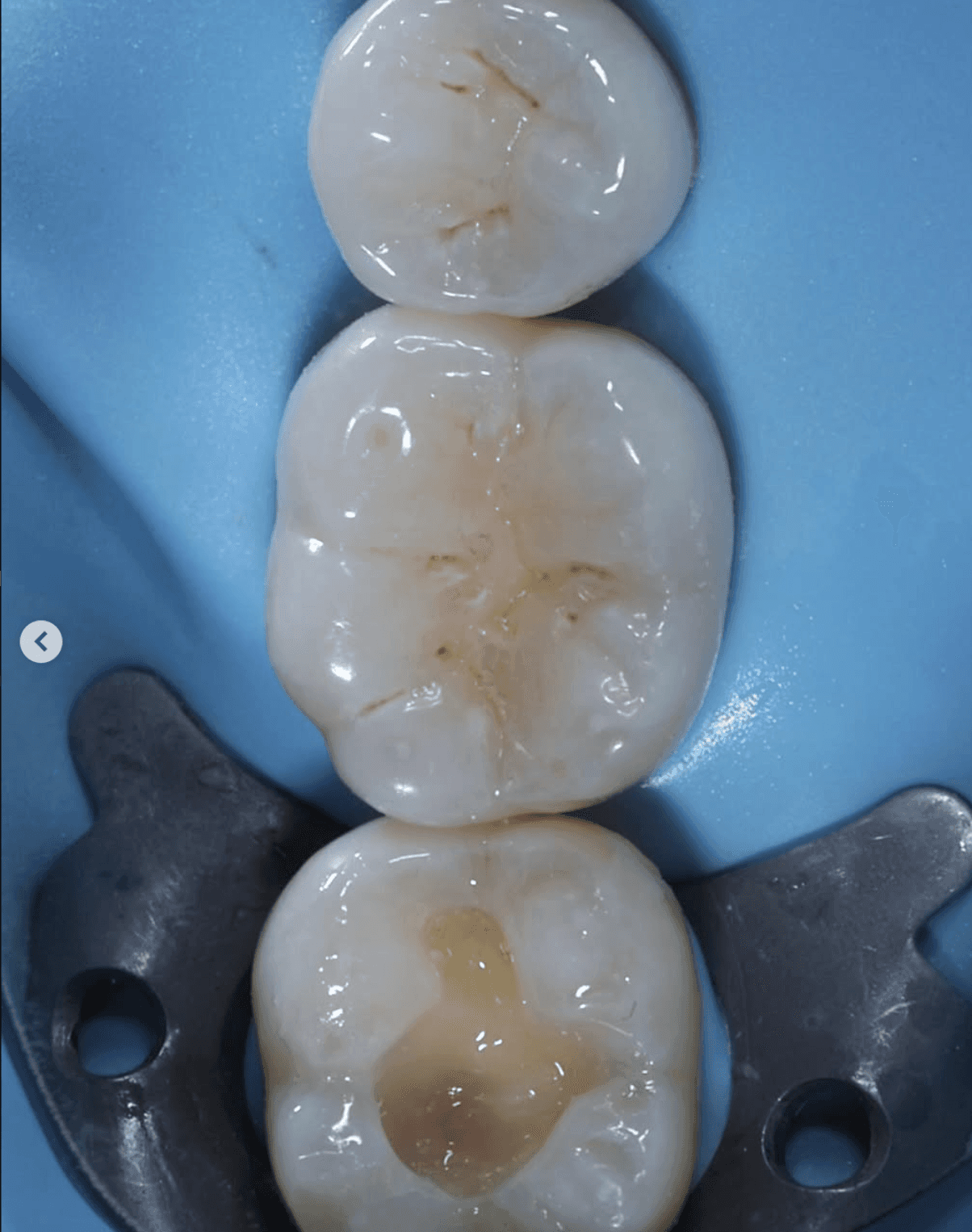 Zahnanatomie: drei kariöse Zähne unter Kofferdam mit Instrumenten
