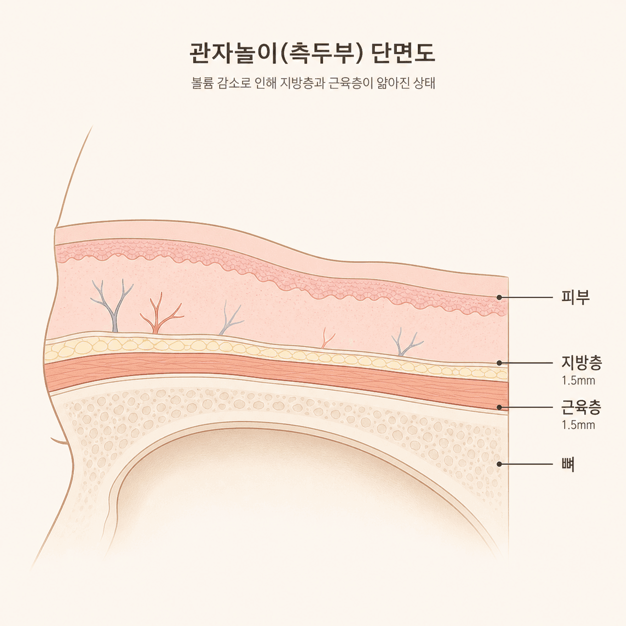 관자 부위에서 함께 얇아지는 층들