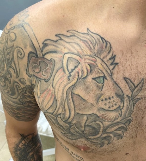 Imagem de antes e depois da remoção de tatuagem