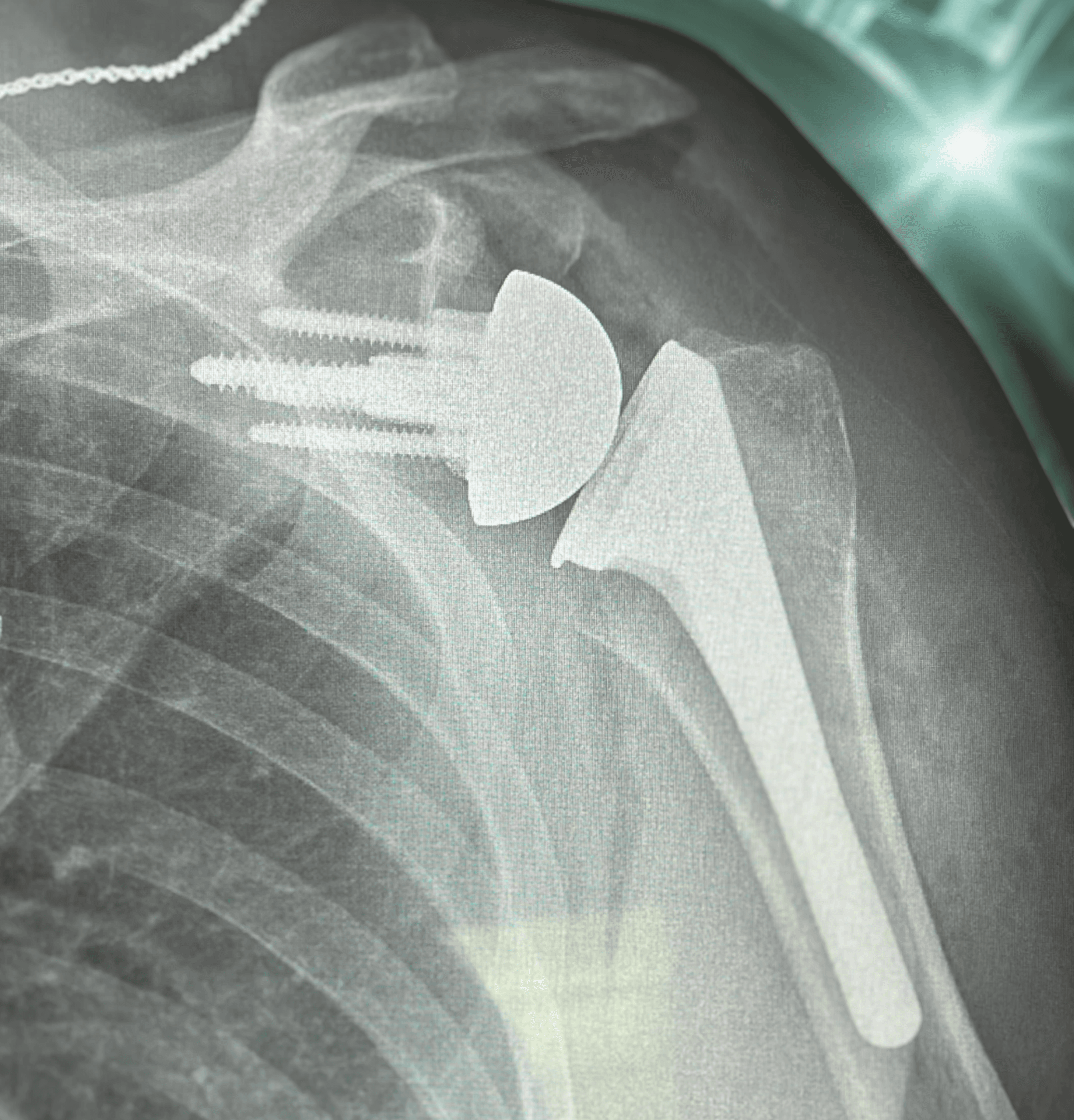 Reverse total shoulder arthoplasty radiograph