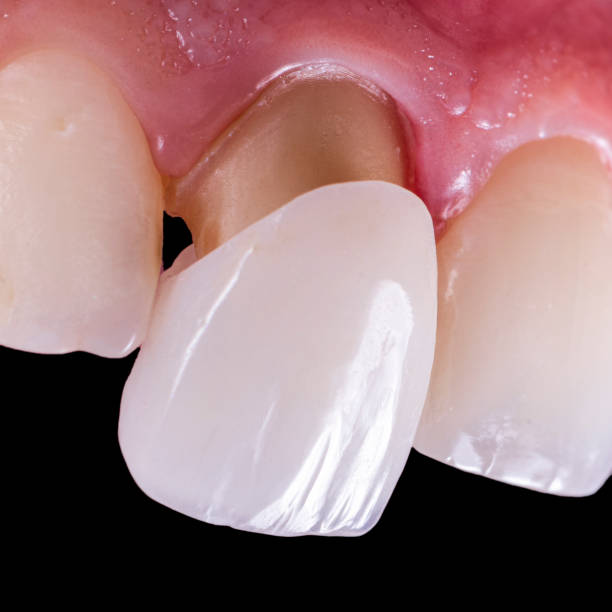 dental crowns