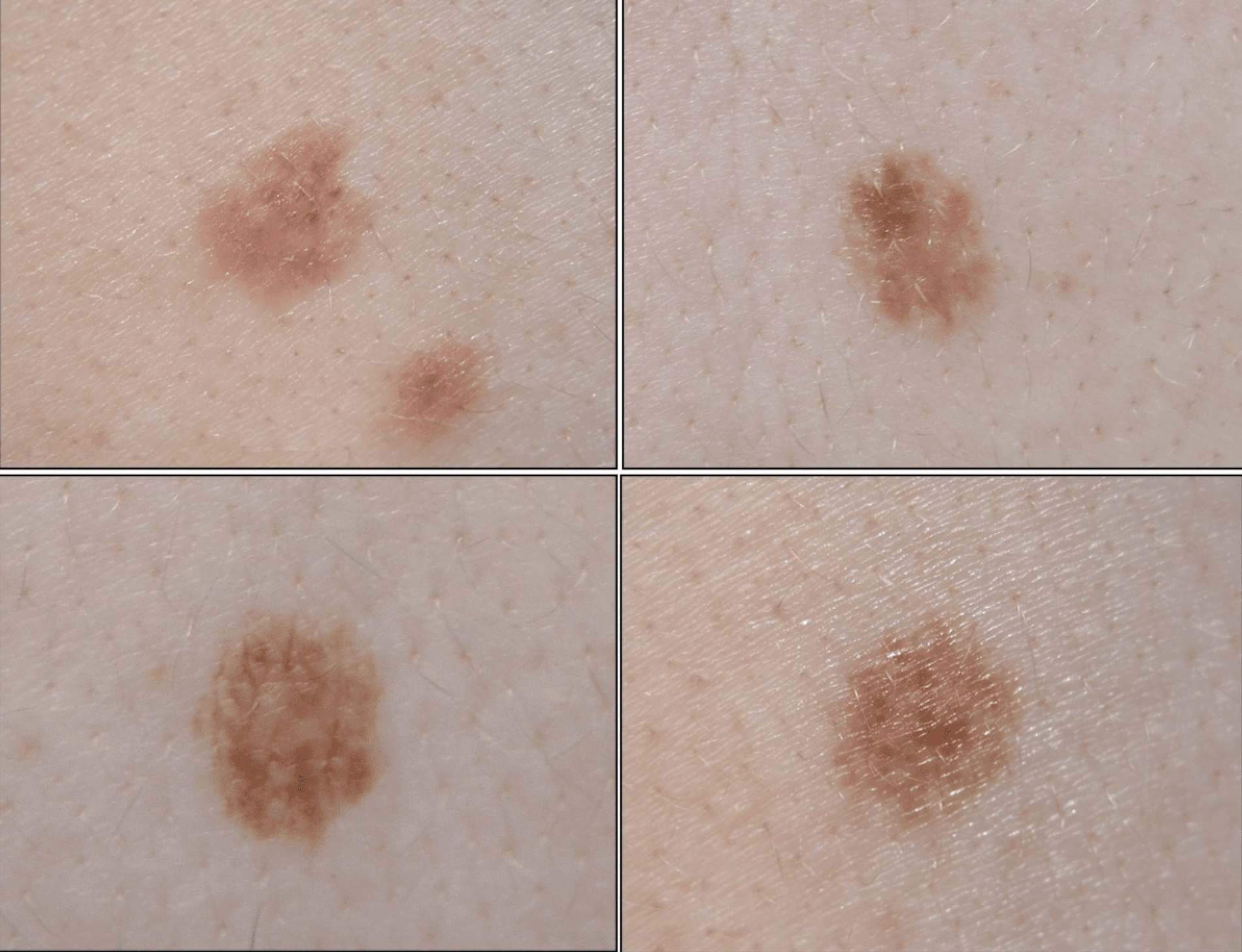 Atypical melanocytic lesions at the dermoscopic level