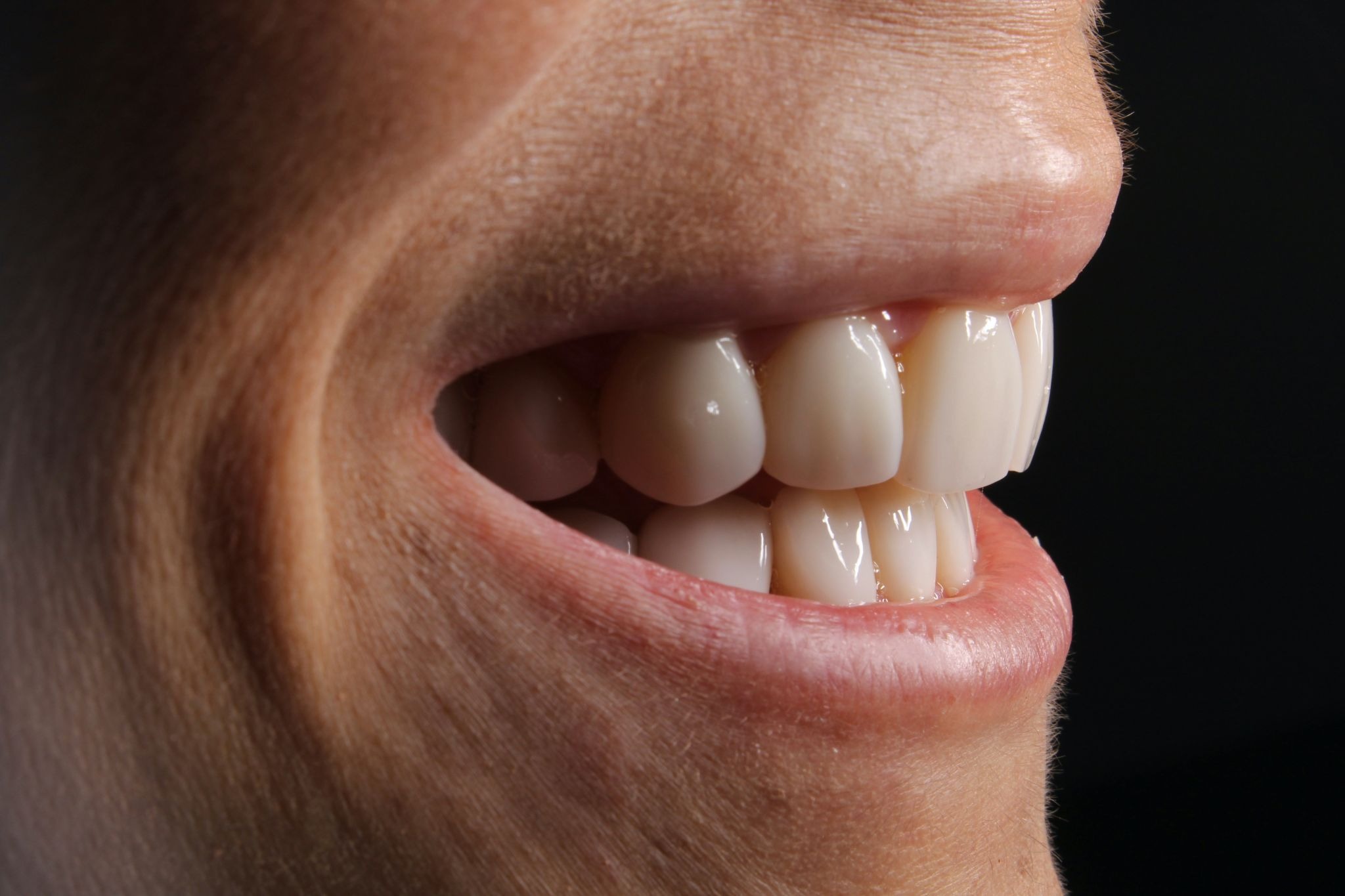 How to Fix Gap Between Teeth