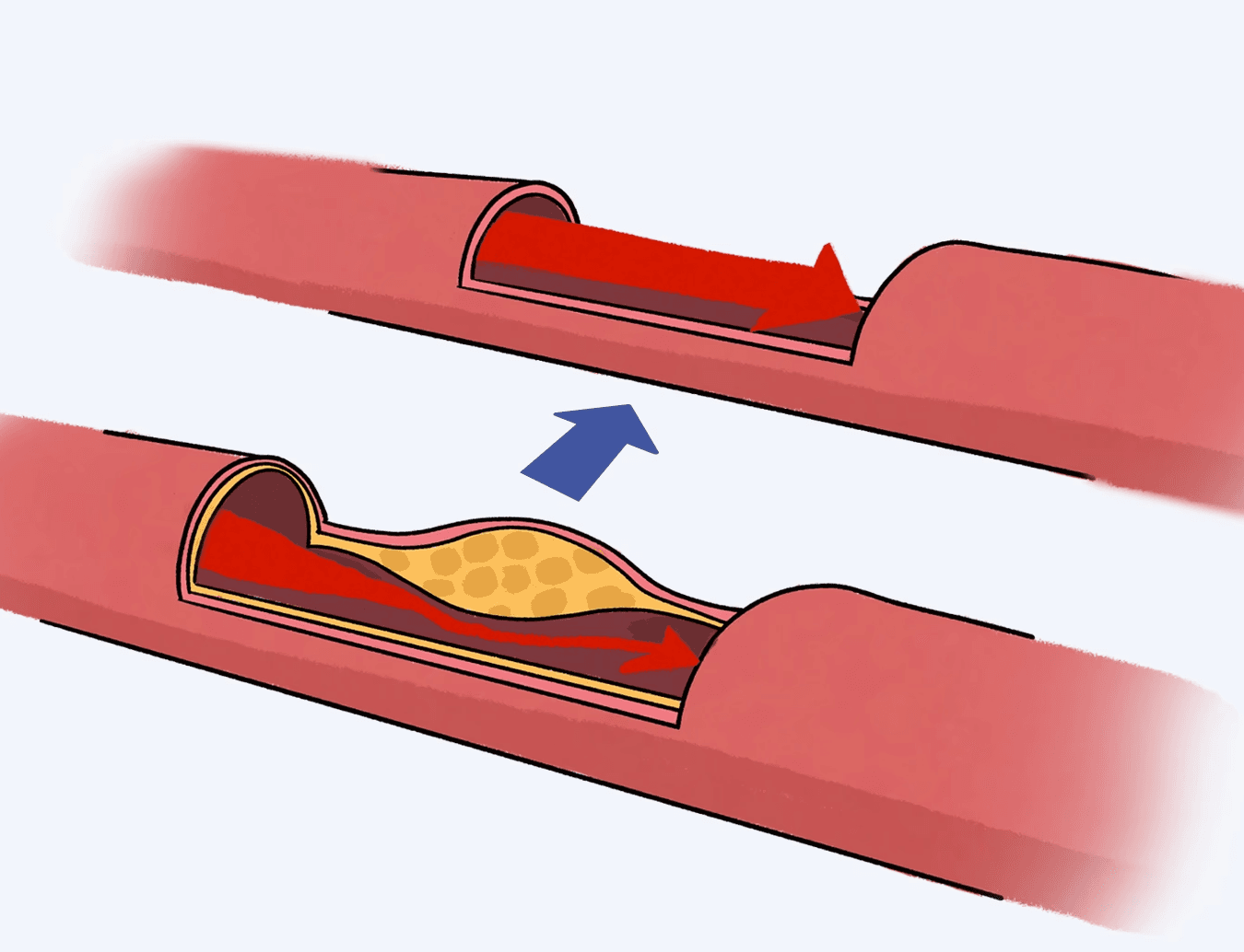 투석혈관 소파술 일러스트