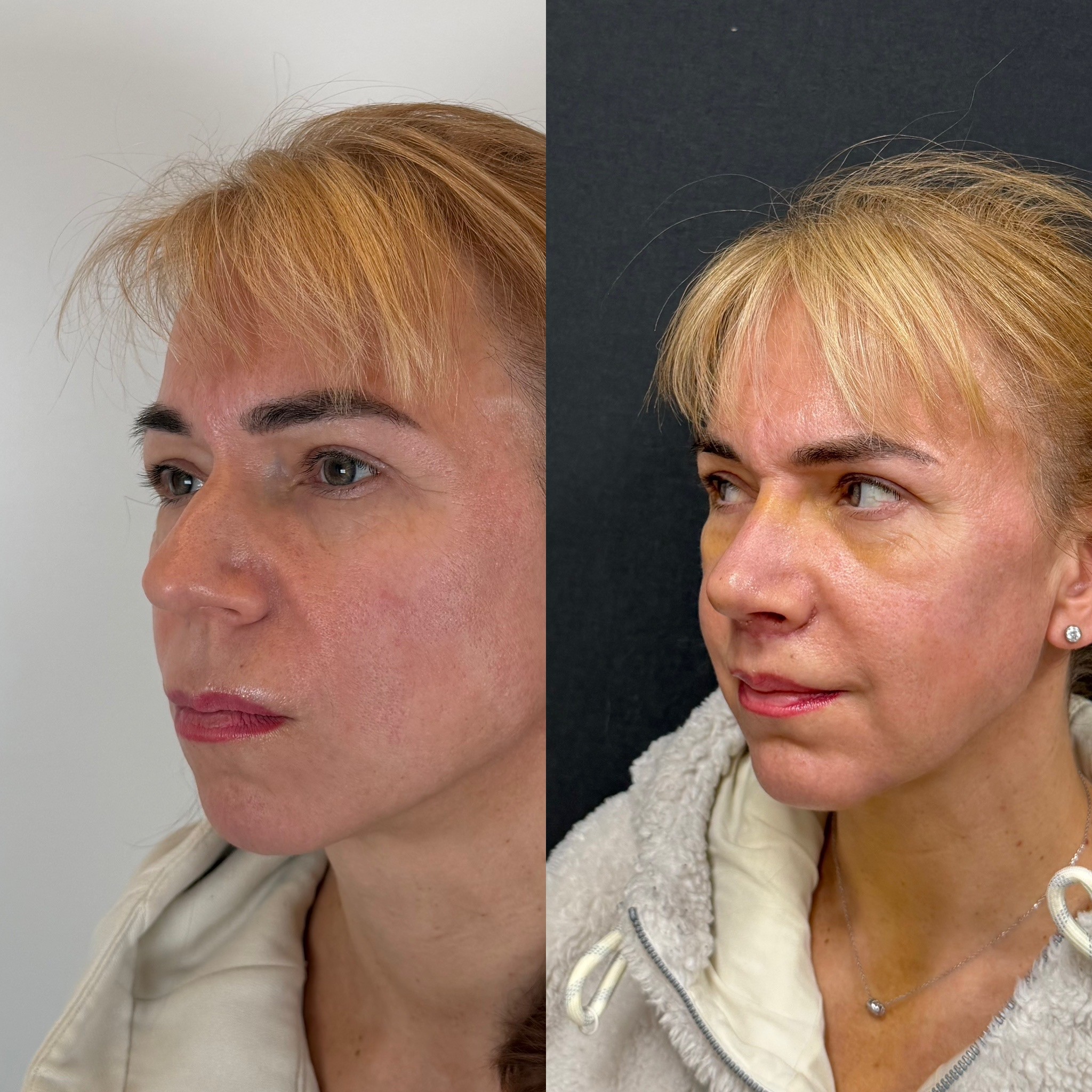 piezo rhinoplasty with chin implant oblique