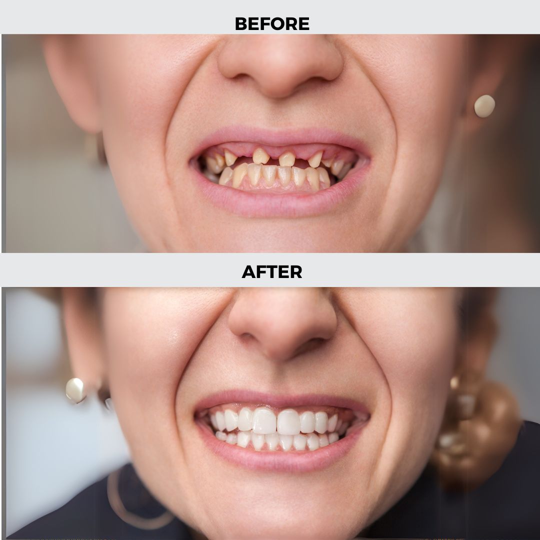 Before and after results of dental implant treatment at Dentistree Dental Clinic Kolkata.