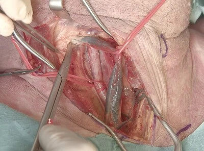 Lateral neck approach for penetrating trauma