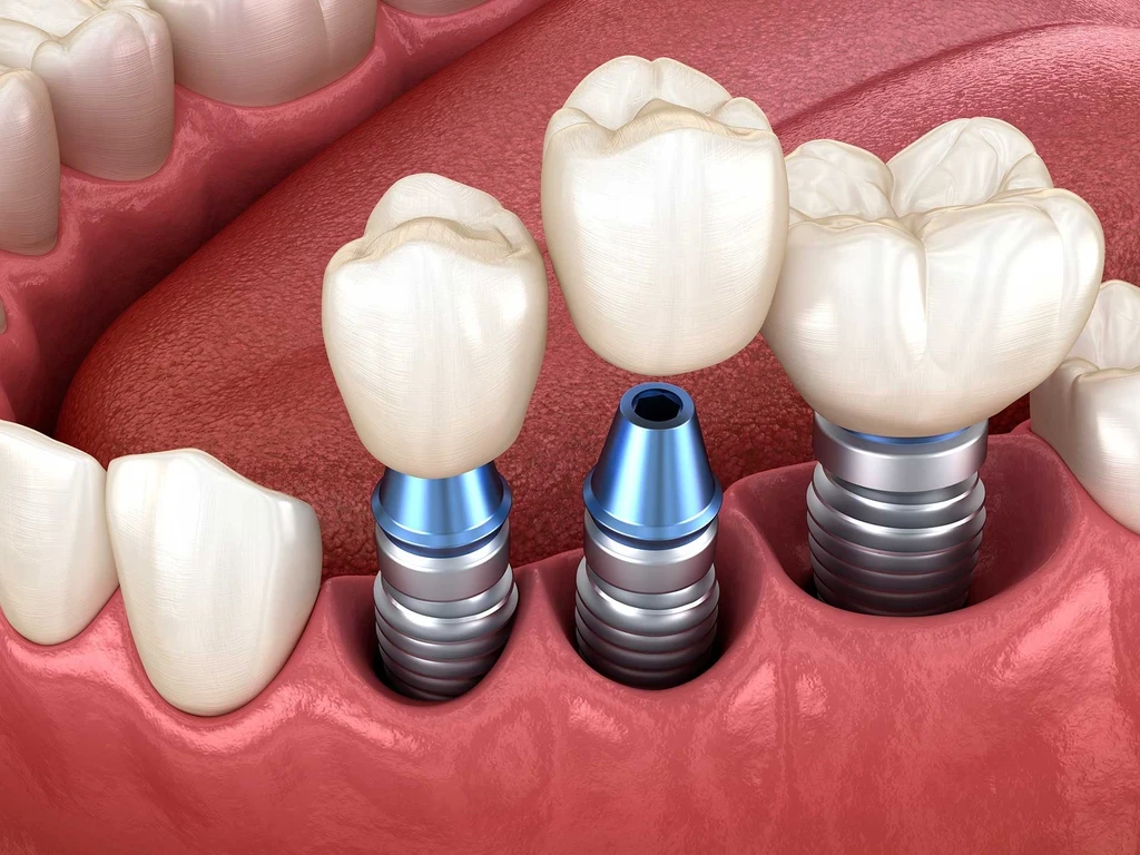 dental implants in Smyrna