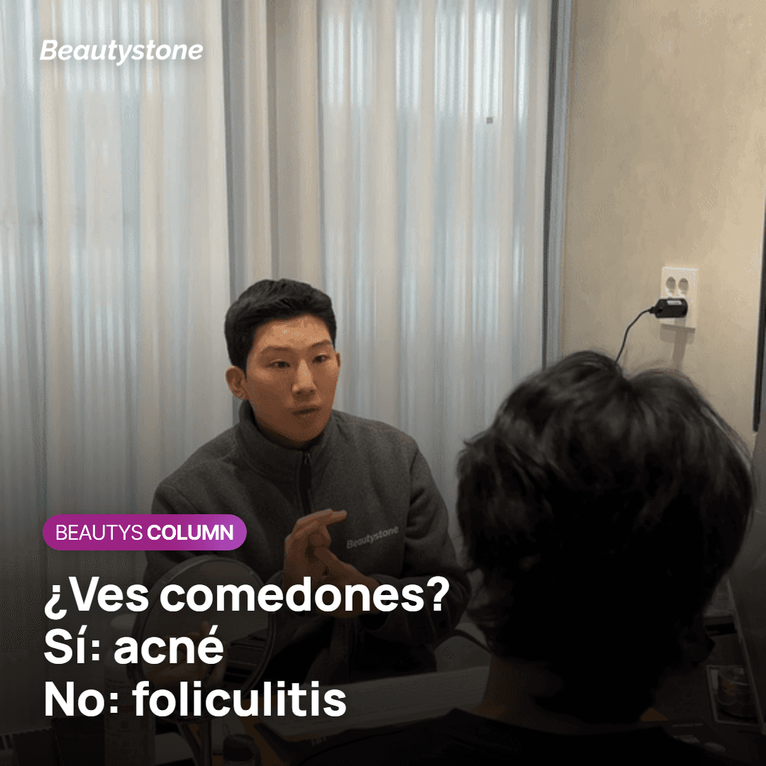 Si hay comedones, es acne
