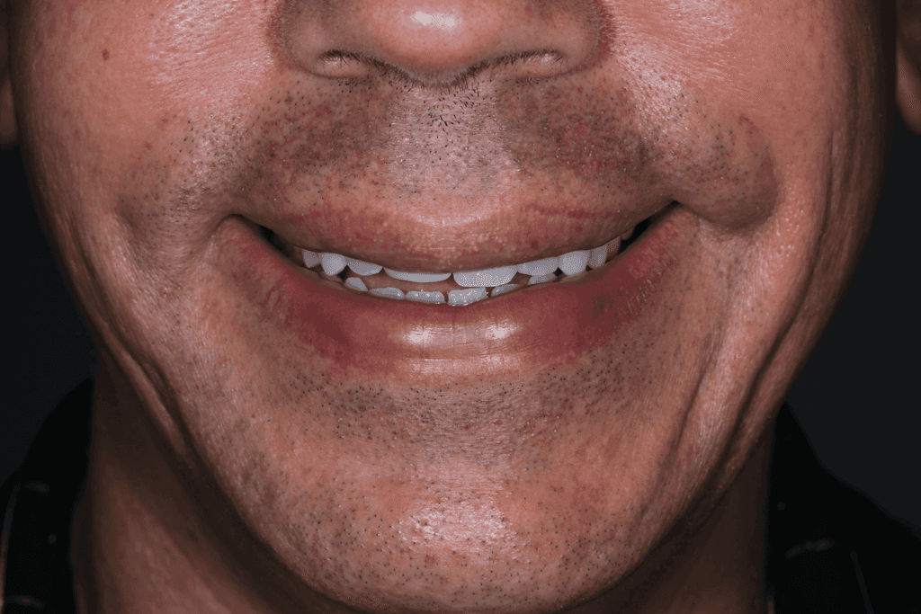 Antes do tratamento ortodôntico