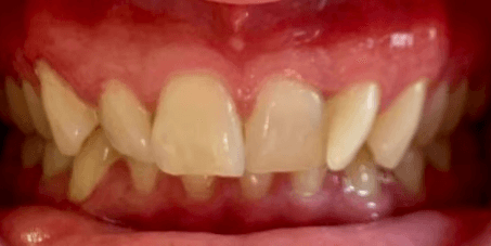 Before clear aligner treatment showing tooth alignment