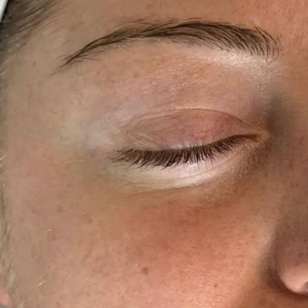 Before barrier repair enzyme facial at The Vancouver Aesthetician — visible dehydration, compromised skin barrier and fine lines on skin