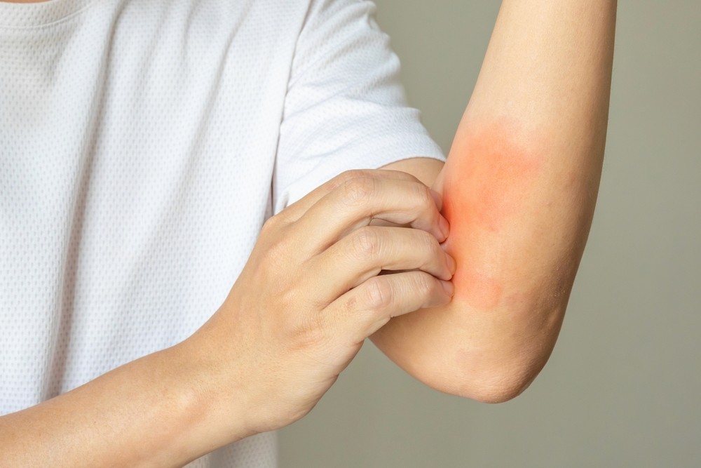 Eczema-affected guy scratching his elbow