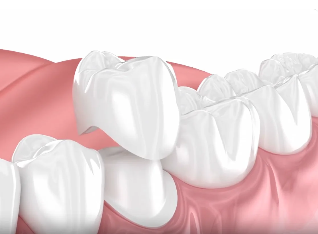 Dental crown treatment information