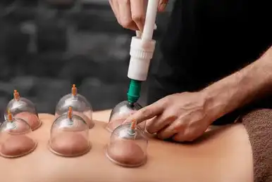 Therapist performing cupping therapy on a patient’s back using vacuum cups for pain relief and improved blood circulation.
