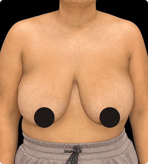 MAMOPLASTIA DE REDUCCIÓN - BEFORE