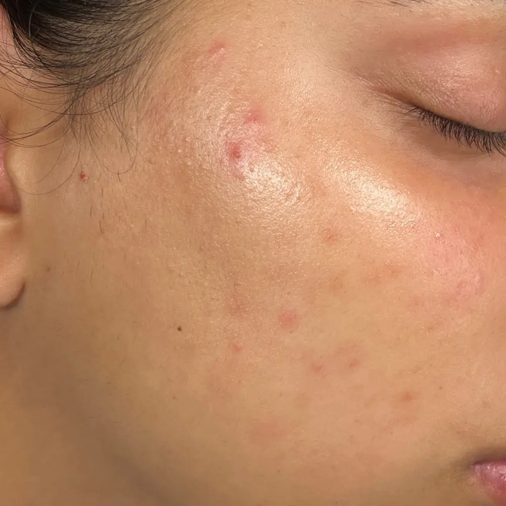 After redness treatment at The Vancouver Aesthetician — severe inflammatory acne completely cleared and redness fully resolved for visibly calm healthy skin