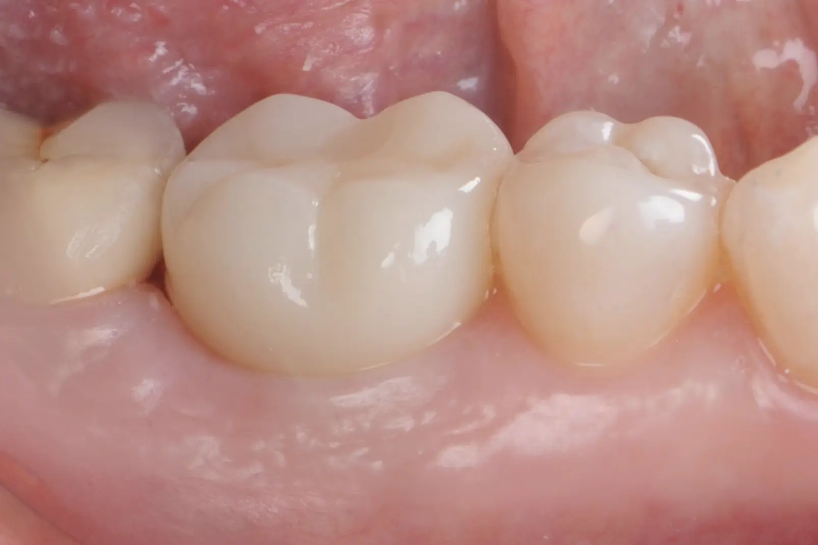 Remplacement d'une dent profondément fracturée, par un implant et une couronne en céramique
