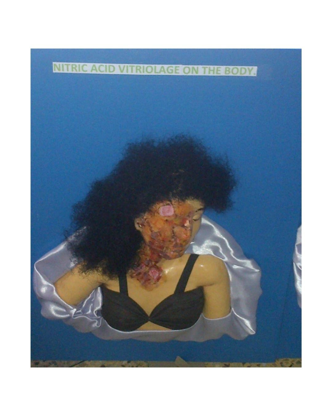 Nitric Acid Vitriolage on the Body