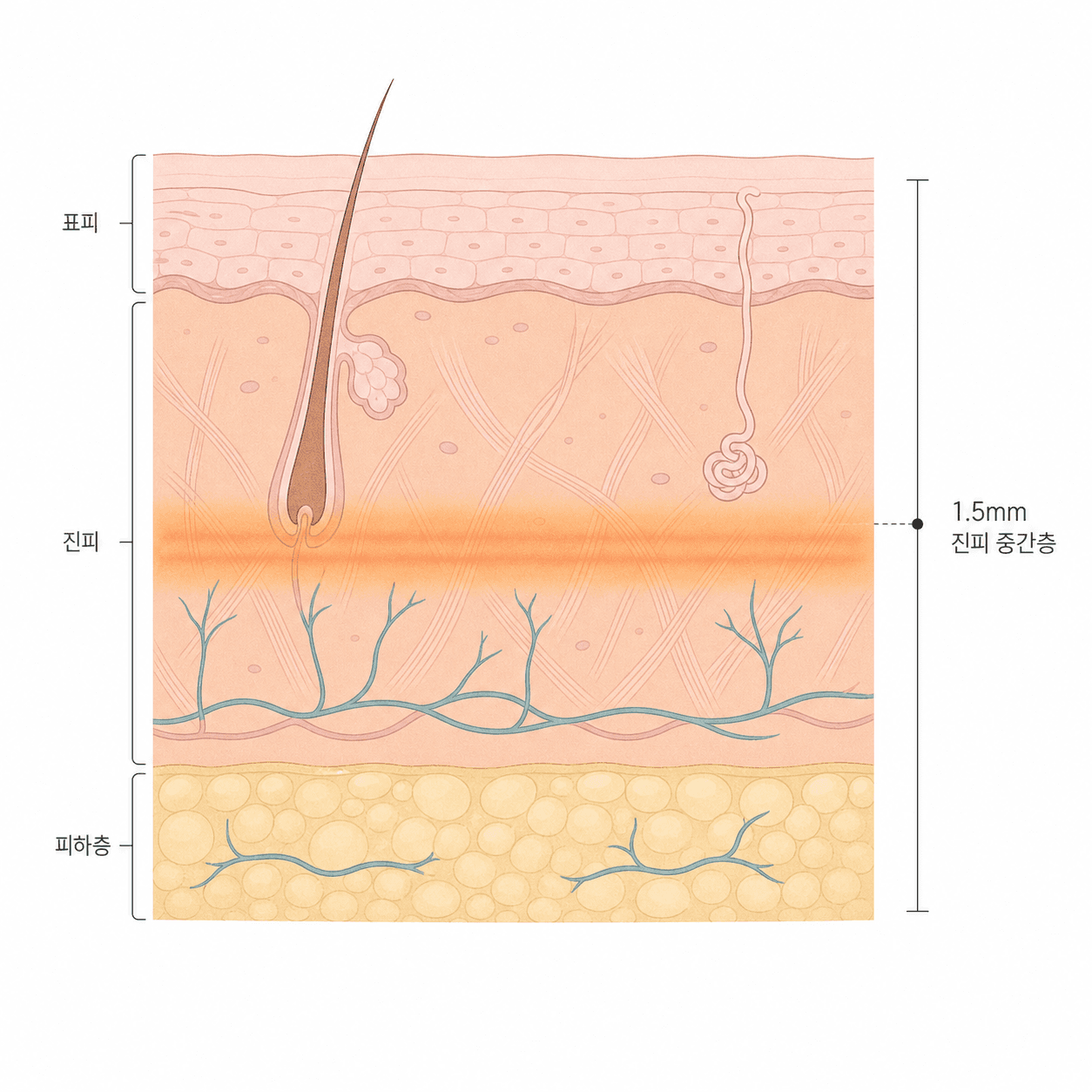 진피 중간층 약 1.5mm 깊이에 열이 전달되는 자리