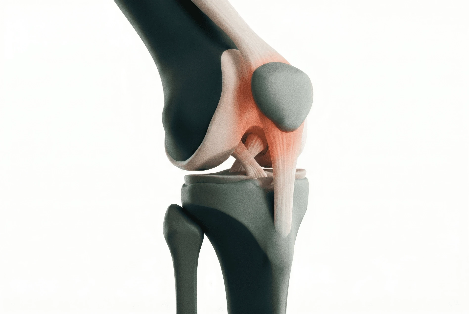Adult Patellofemoral Pain
