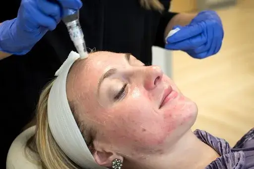 Woman undergoing microneedling procedure to improve skin texture, reduce acne scars, and minimize fine lines.