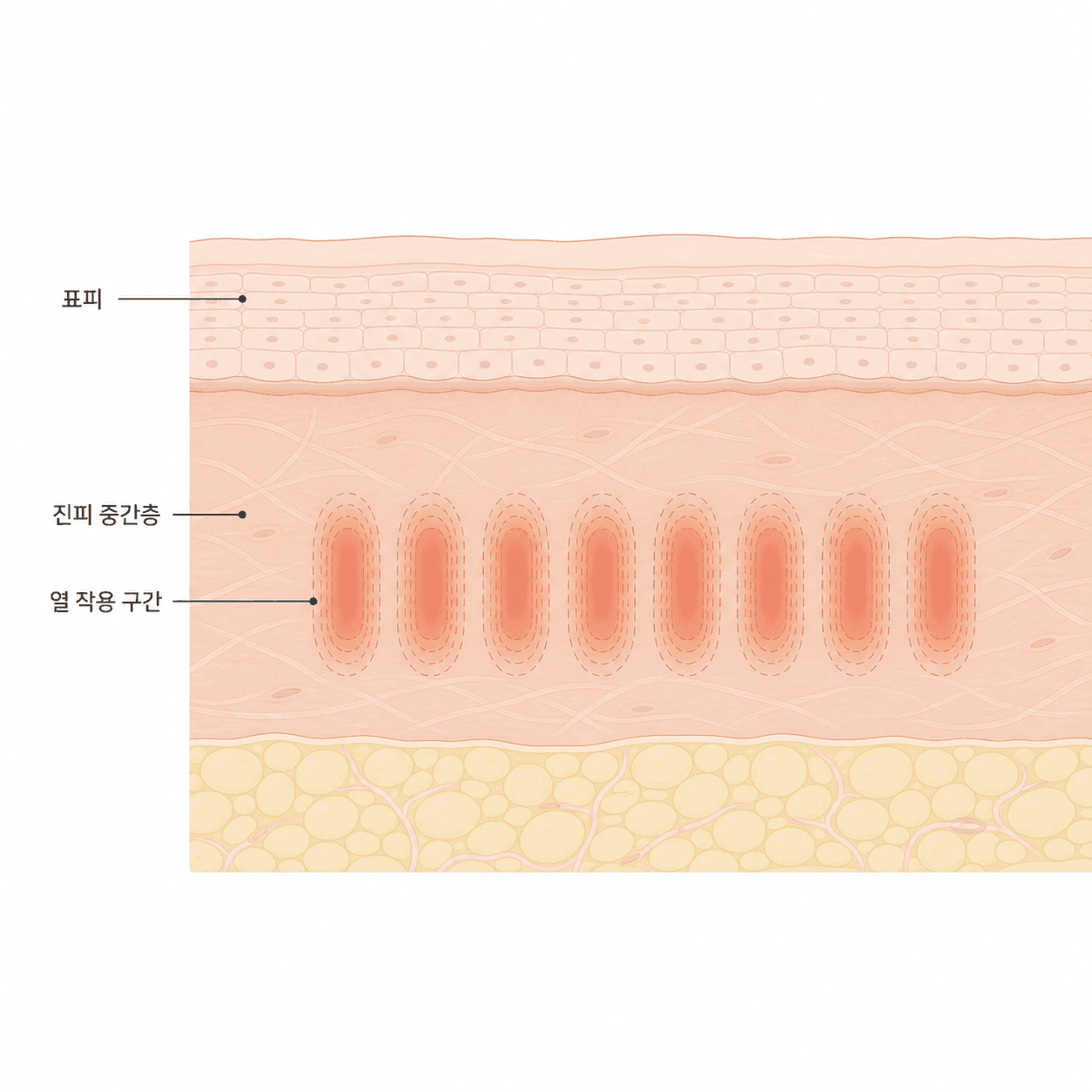 표피를 지나 진피 중간층에 작동하는 열 구간