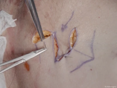 Skin transposition flap