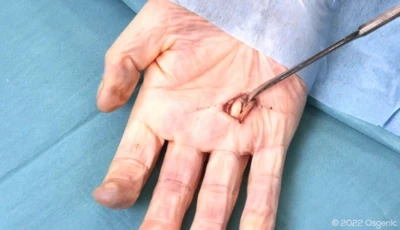 Trigger finger release