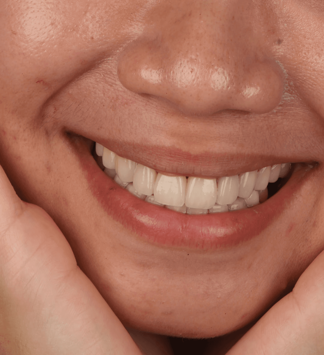 Patient smiling with natural-looking porcelain veneers at Ora Dental Makati