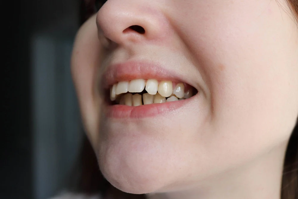 overbite