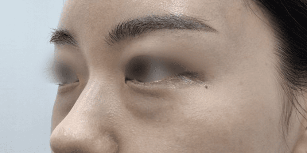 Undereye Filler - Before