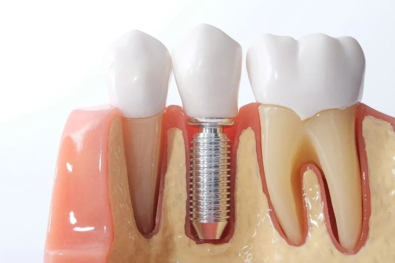 Management of Peri-implantitis in Toronto | Bloor-Yorkville Periodontics