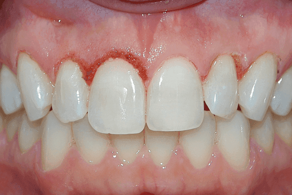 Gengivoplastia