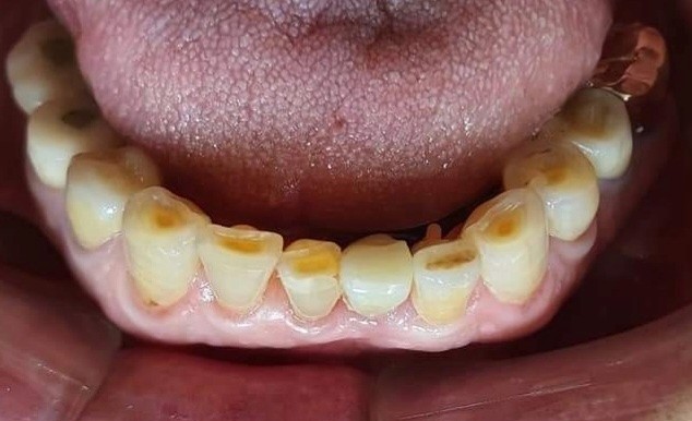 31번이 보철이라 하는데, 강냉이닷컴은 32번을 제작했어요