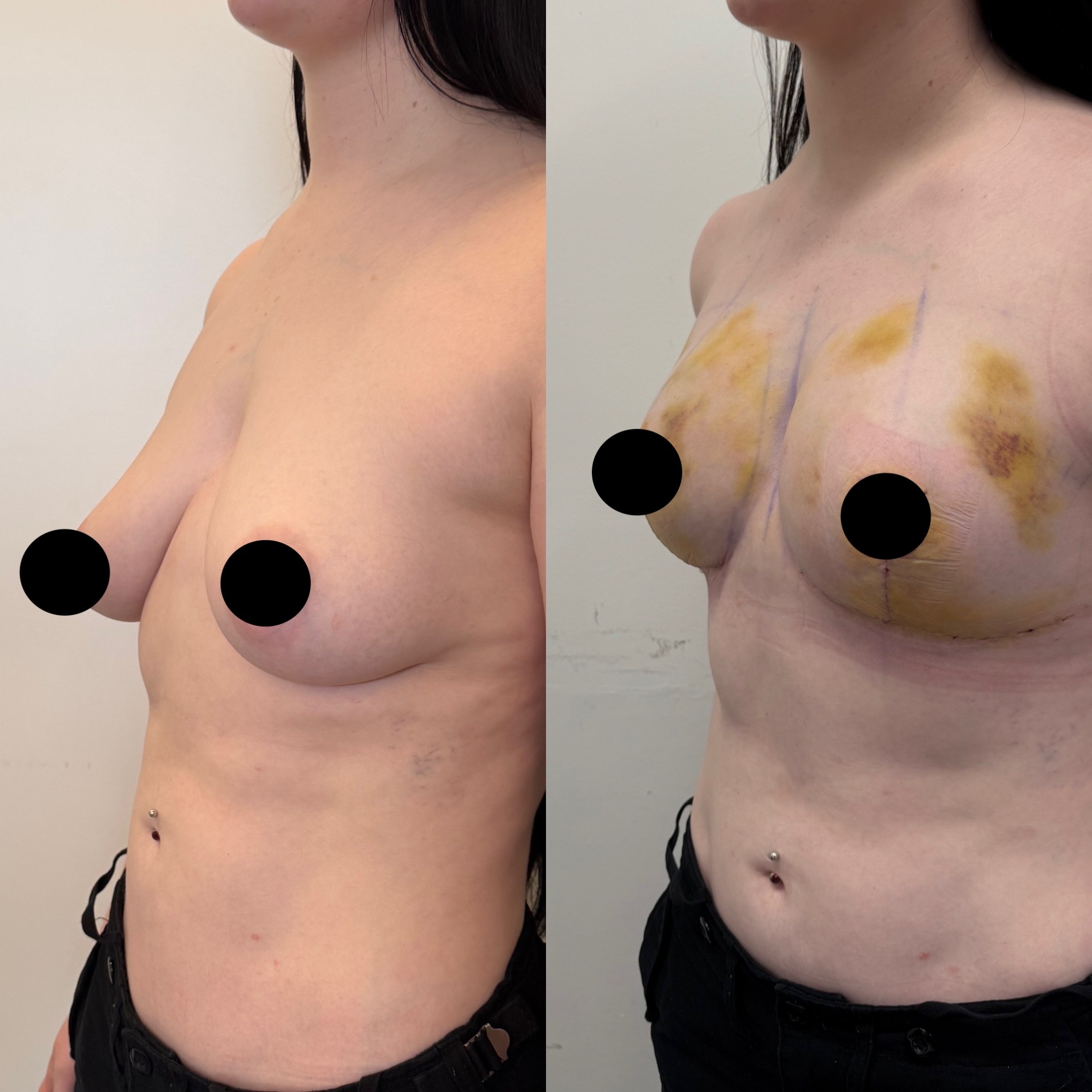 breast lift and fat injection before after left oblique view