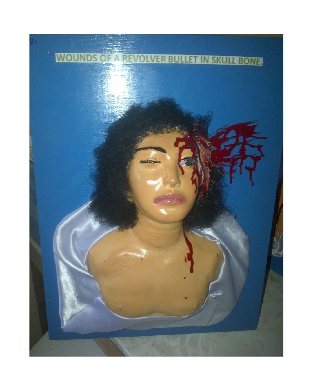 Wounds of a Revolver Bullet in Skull Bone