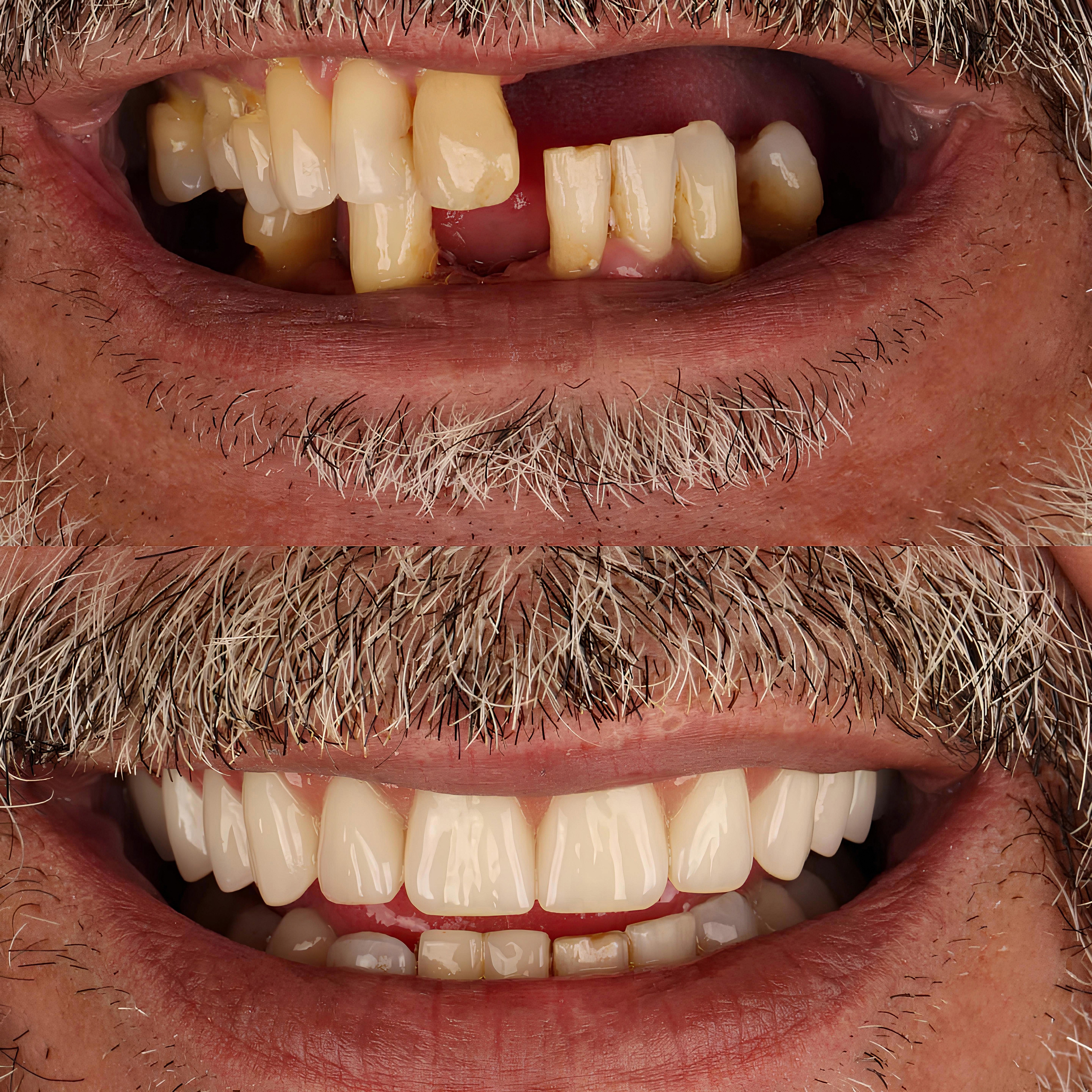 Replace missing teeth with dental implants