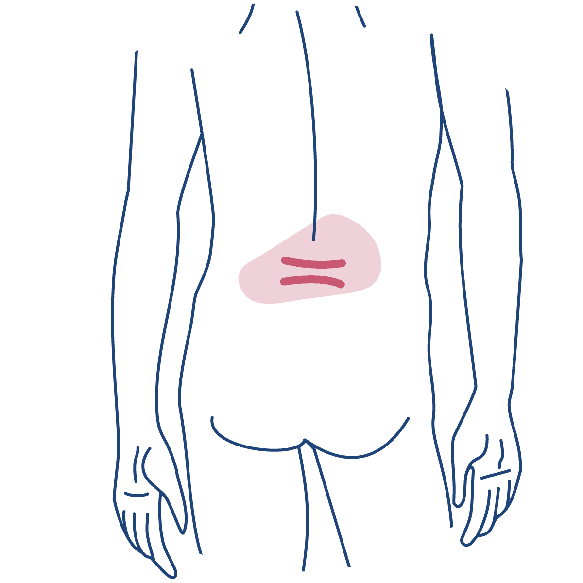 Homem desenhado de costas em linhas azuis, com dois traços em rosa escuro representando a hérnia comprimida.