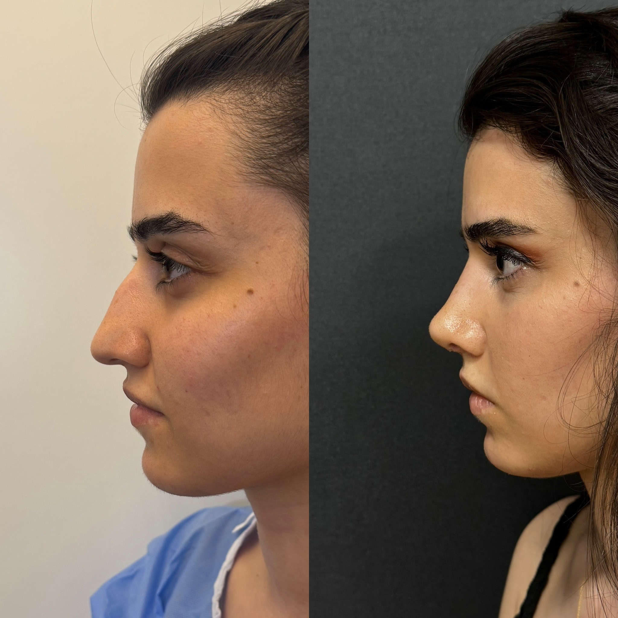 20 days post-op before after rhinoplasty patient side view