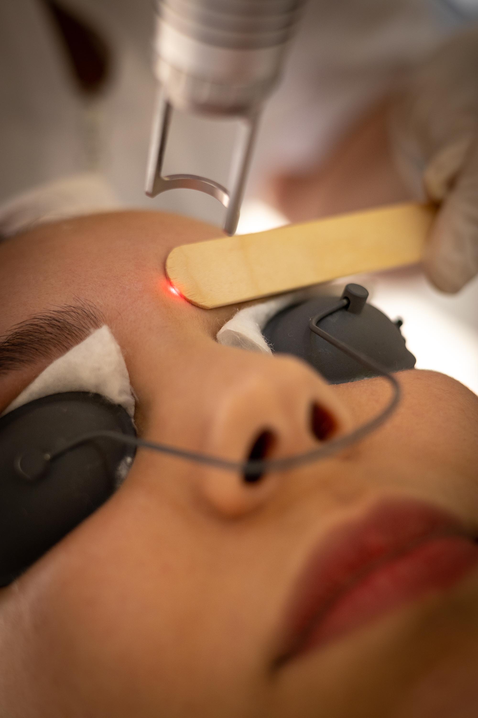 Technologies used for different types of laser hair removal