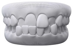 Cross bite teeth