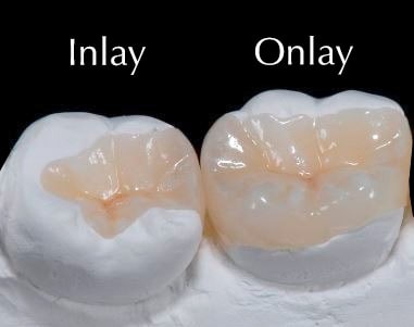veneers