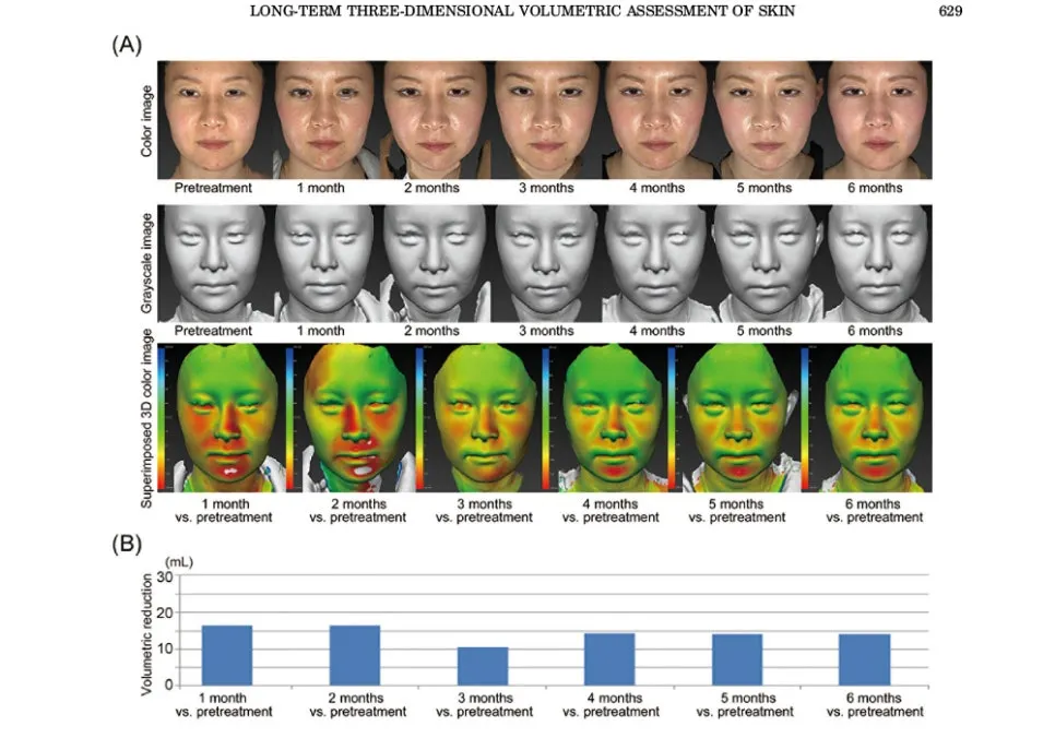 potenza rf micronnedling results during 6 months