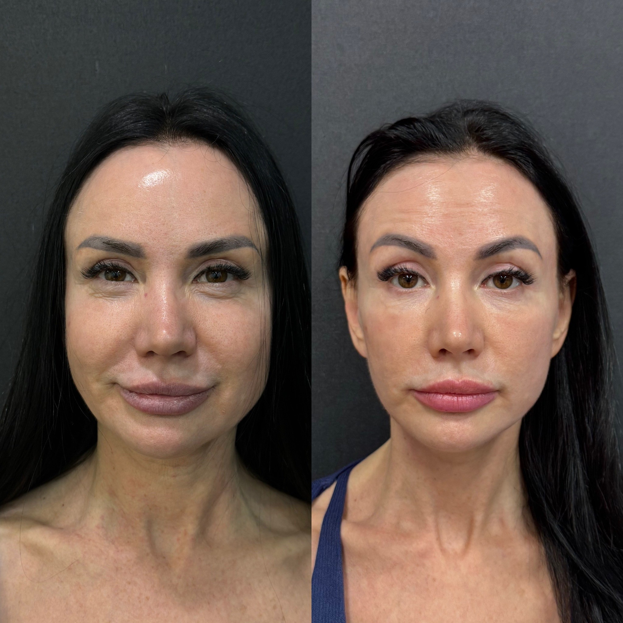 lower face & neck lift before after front view