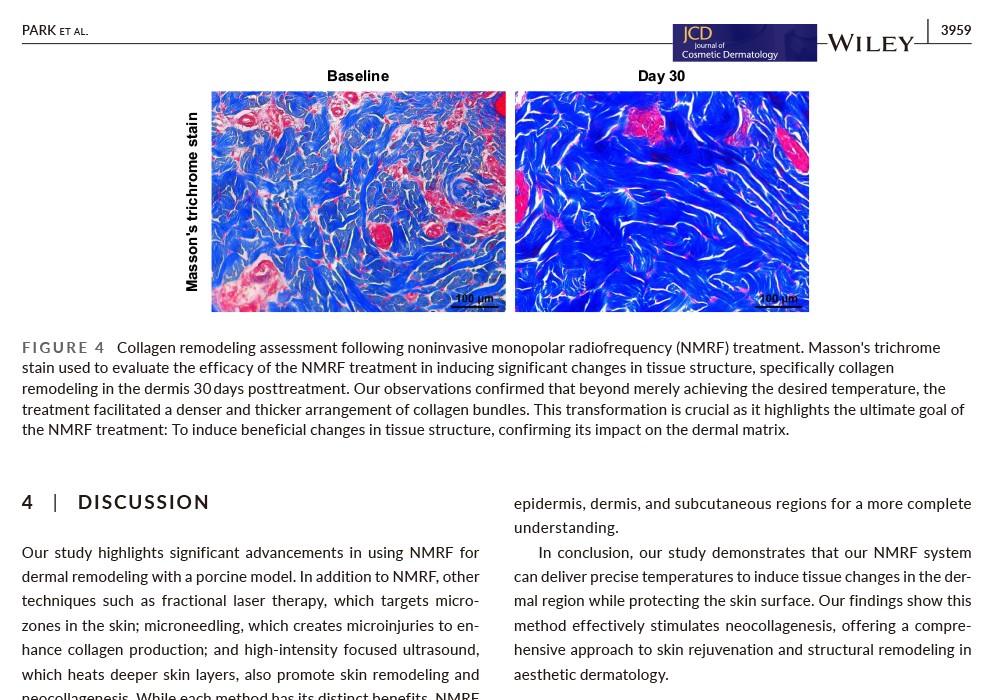  Monopolar radiofrequency for dermal temperature regulation and remodeling: A porcine model study