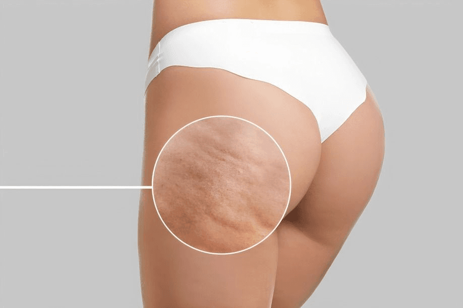 Celllfina® en Terrassa, Barcelona. En Heaven Clinics